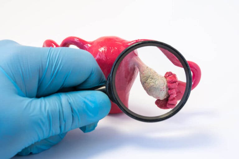 Qué es el cistoadenoma mucinoso gigante de ovario