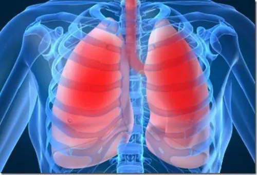 Alcalosis respiratoria