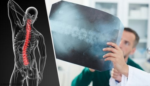Angiodisgenesia espinal