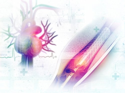 Angioplastia coronaria