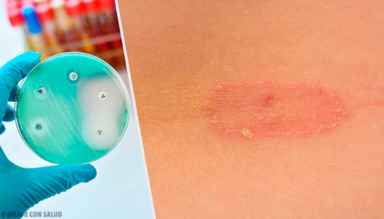 Blastomicosis