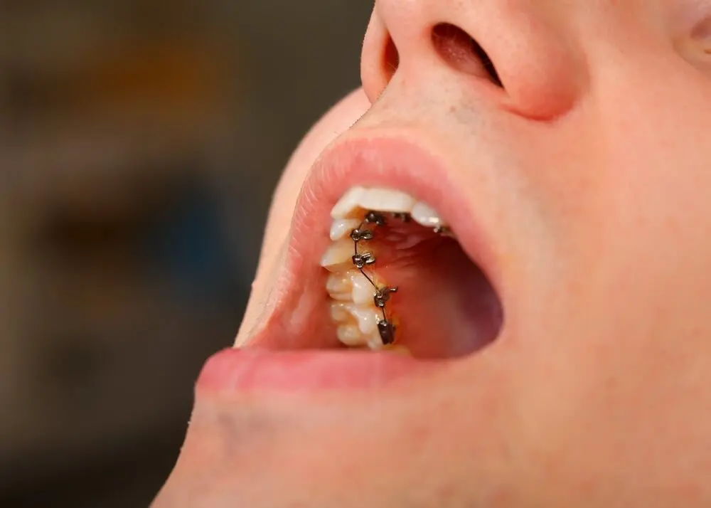 Brackets linguales