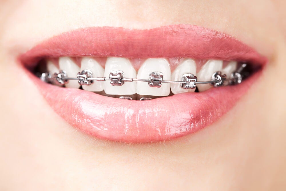 Brackets metálicos, un tratamiento dental muy eficaz
