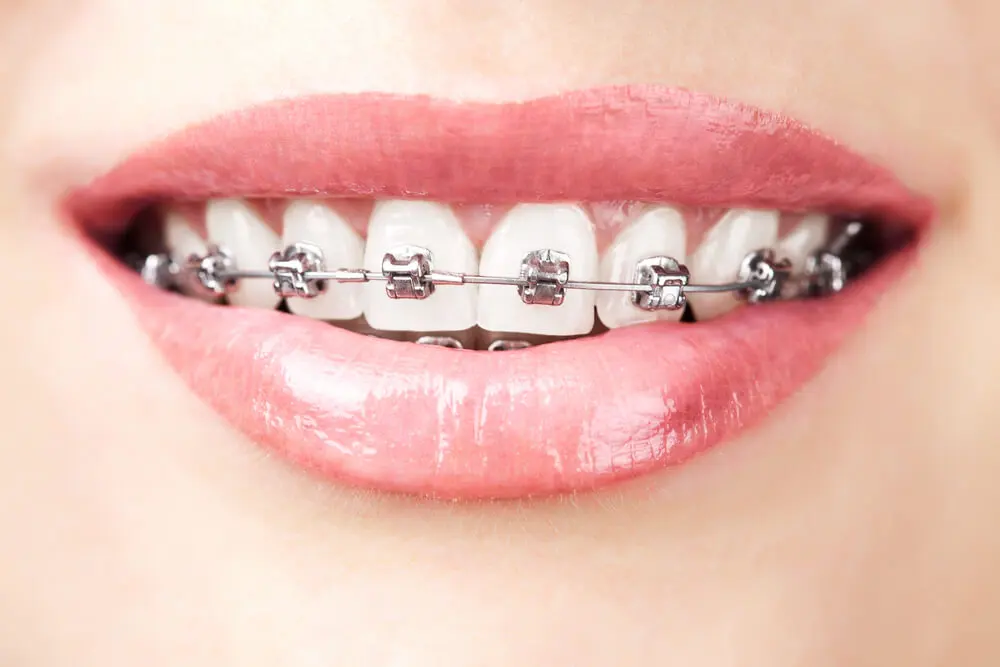 Dientes con ortodoncia. Tratamiento para agenesia dental.