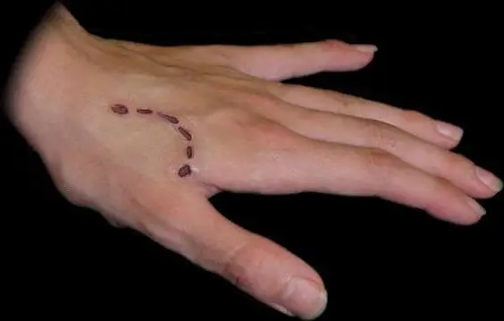 Cuidado de la herida