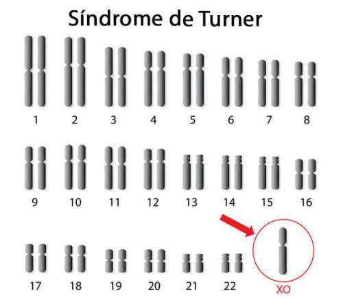 Cuales-son-los-síntomas-más-comunes-del-sindrome-de-Turner.