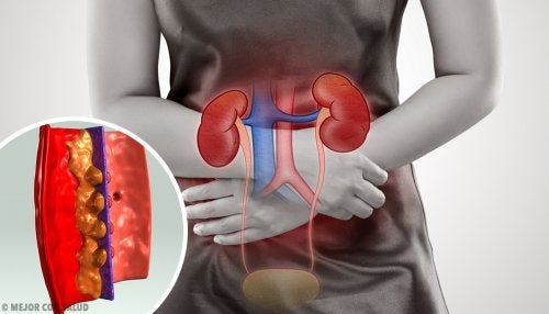 Glomerulonefritis