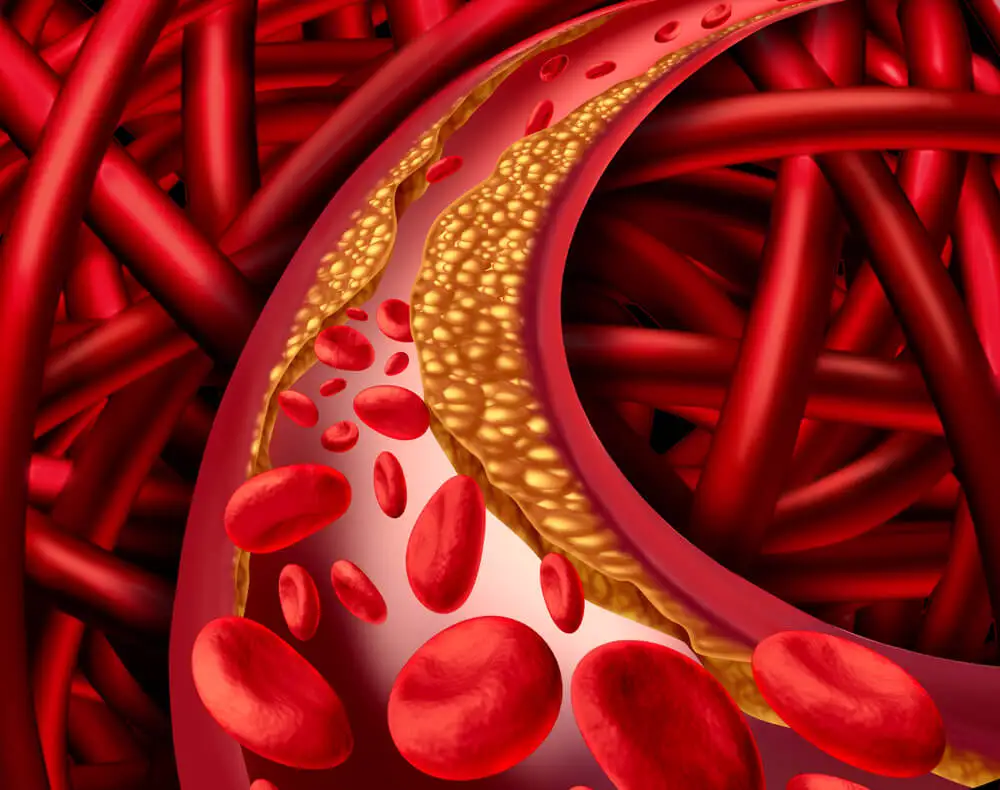 Hipercolesterolemia