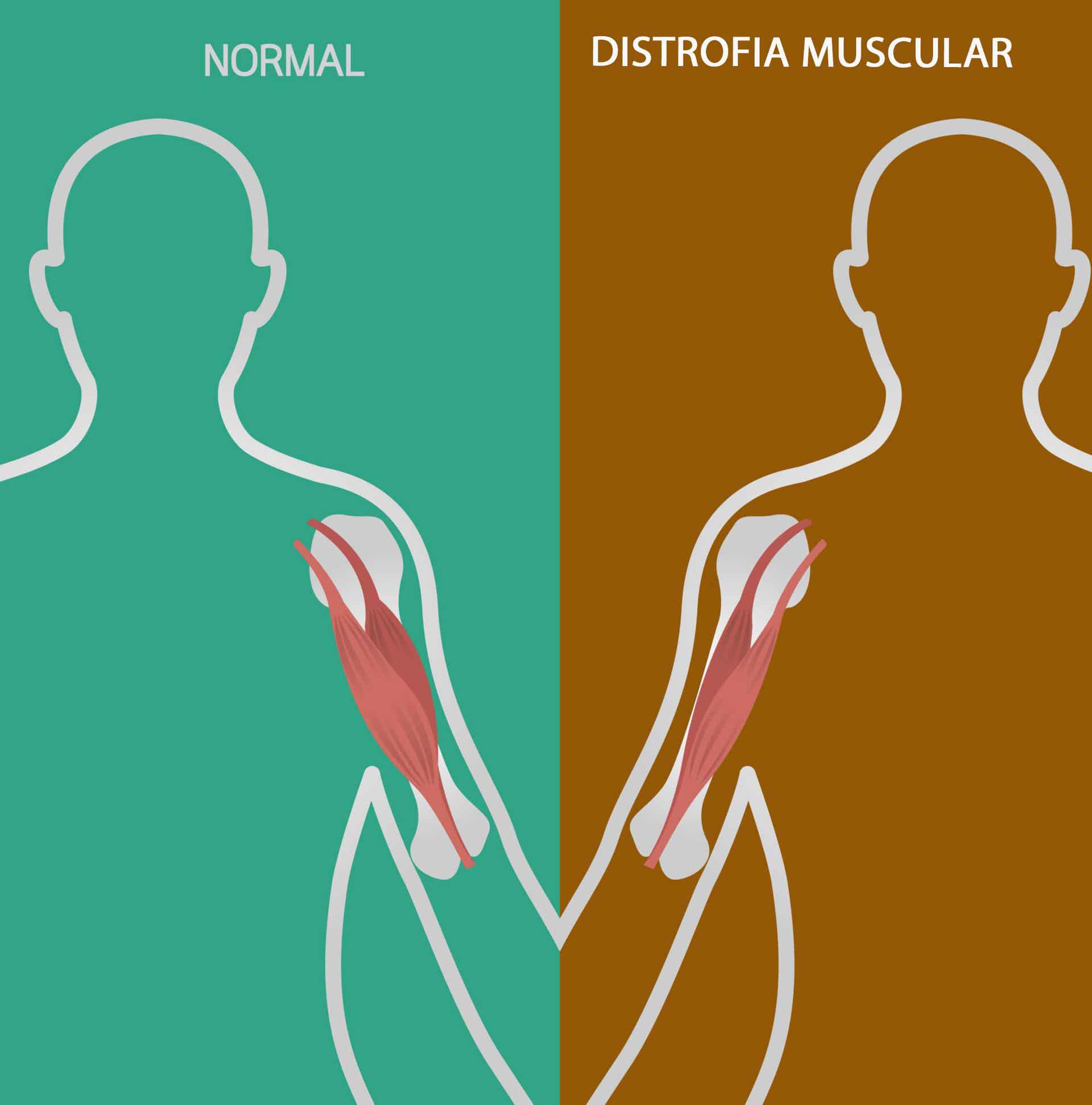 La distrofia muscular de Duchenne