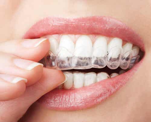 La ortodoncia invisible, una alternativa a los brackets
