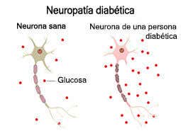 neuropatía diabética y Cymbalta