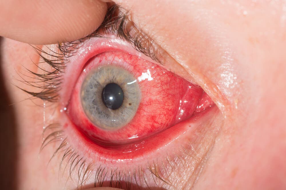 Que es la conjuntivitis