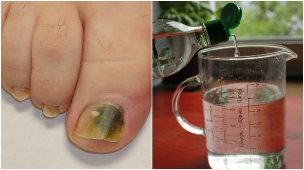 Comprometido frecuencia Limpia el cuarto Receta a base de alcohol e ingredientes naturales para combatir los hongos  en las uñas - Mejor con Salud