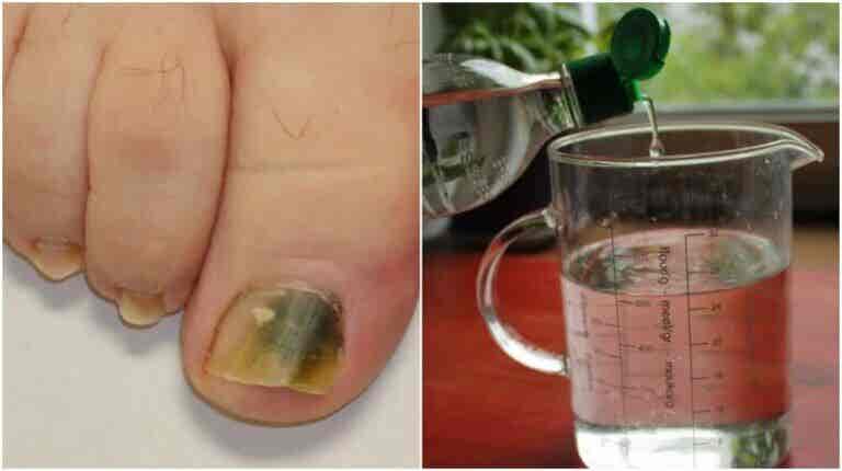Receta a base de alcohol e ingredientes naturales para combatir los hongos en las uñas