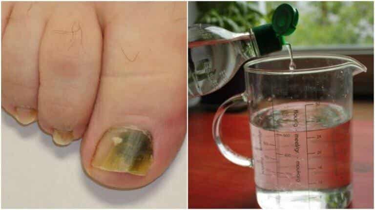 Receta a base de alcohol e ingredientes naturales para combatir los hongos en las uñas