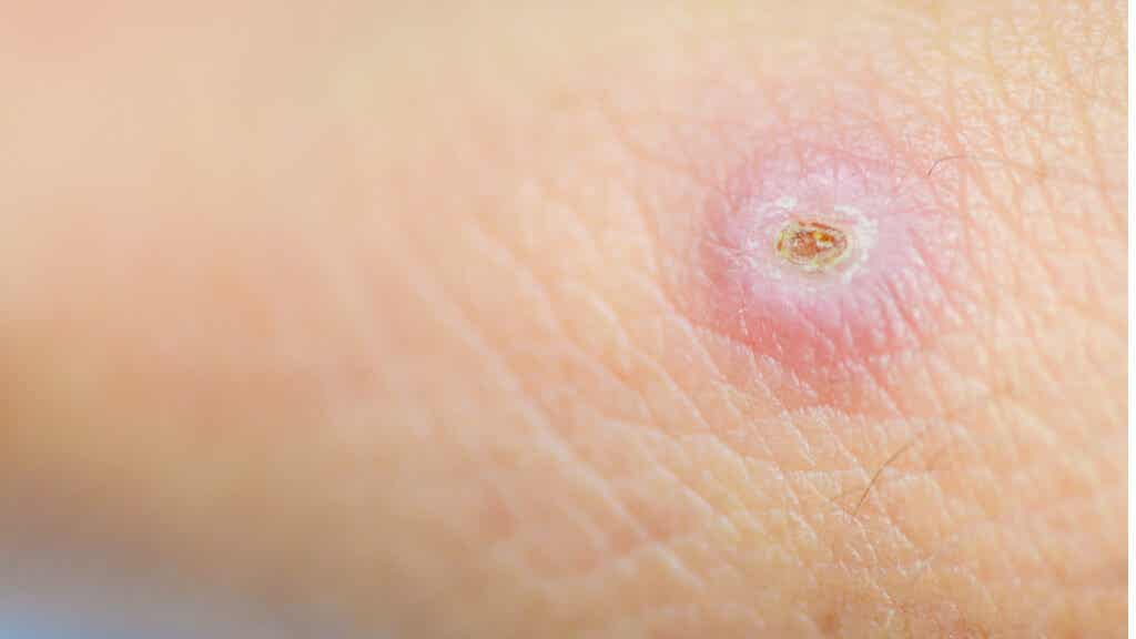 ¿Qué son los forúnculos? 7 consejos para combatirlos - Mejor con Salud