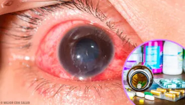 Tratamiento de la conjuntivitis