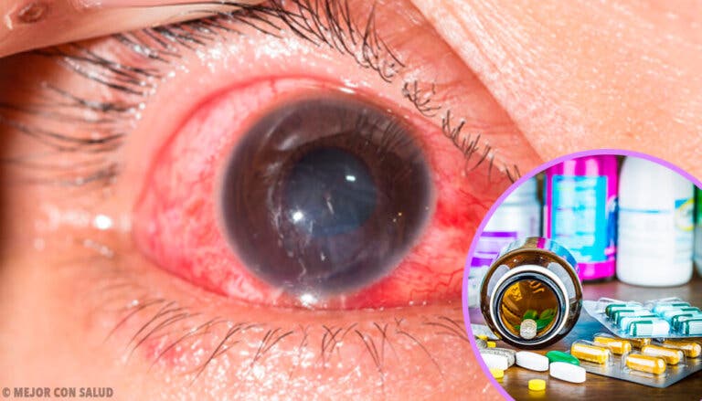 Tratamiento de la conjuntivitis