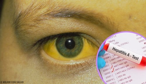 Tratamiento de la hepatitis A