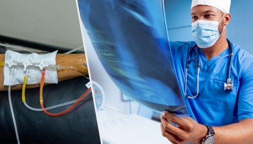 Tratamiento del cáncer de pulmón