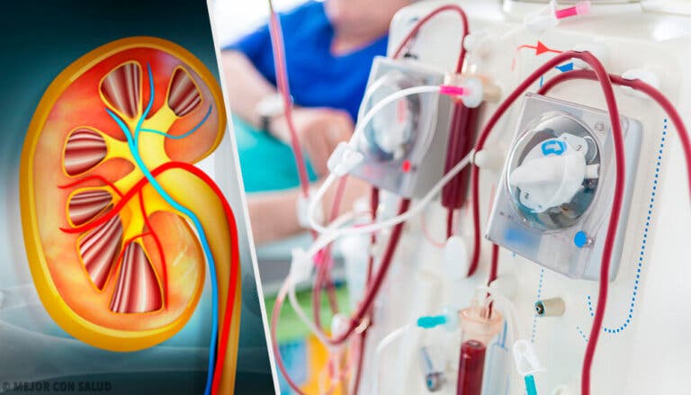 Tratamiento del síndrome nefrítico