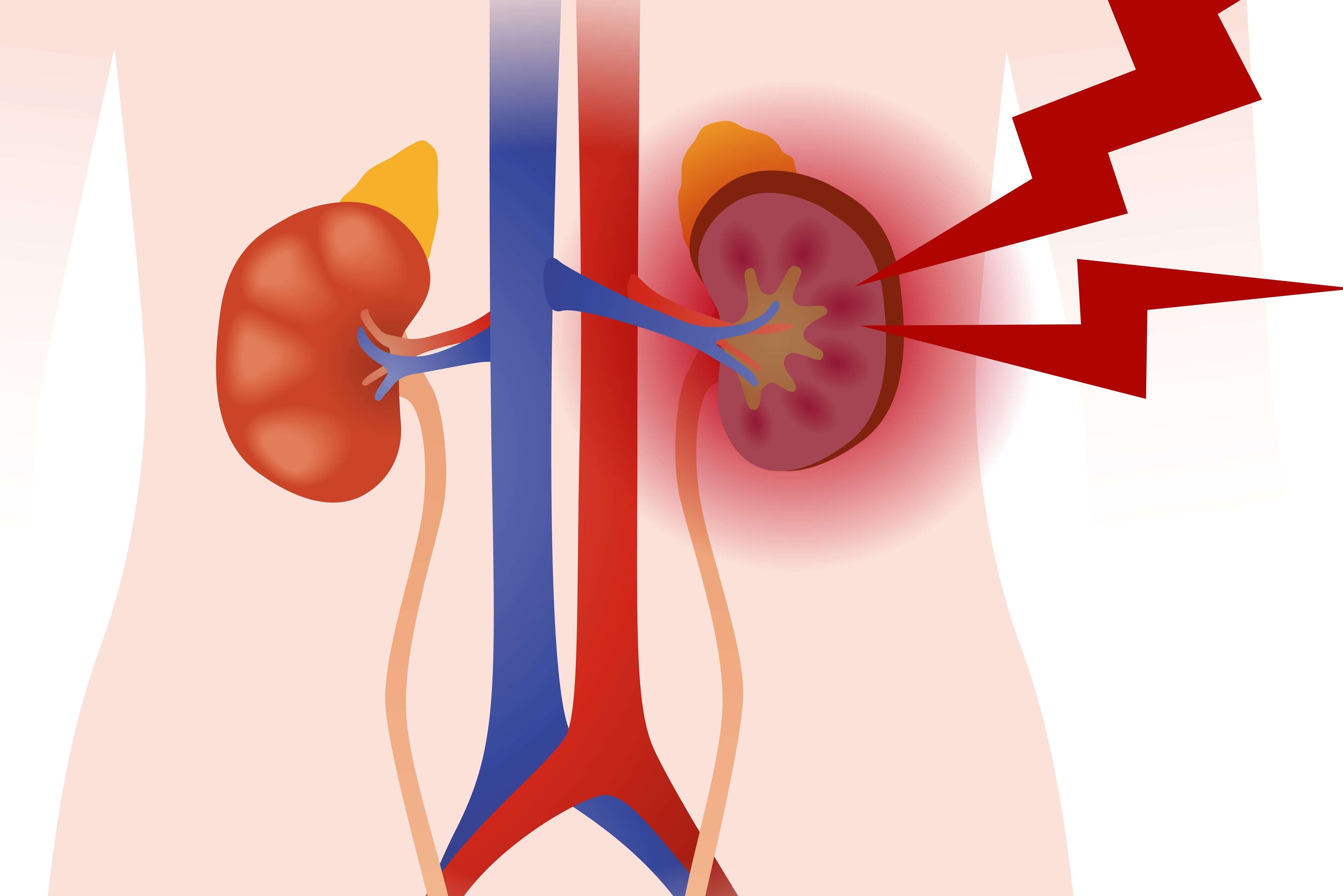 Vasculitis (inflamación de los vasos sanguíneos)