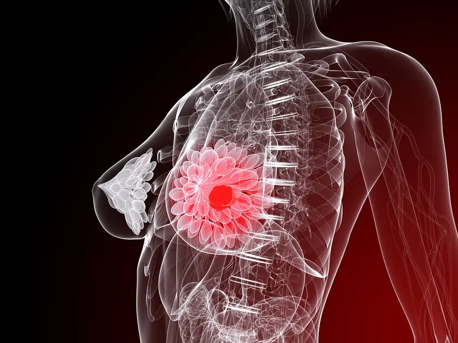 Cáncer de mama, ilustración anatómica.