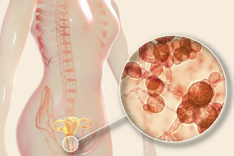 Estas son las causas, síntomas y tratamiento de la candidiasis vaginal
