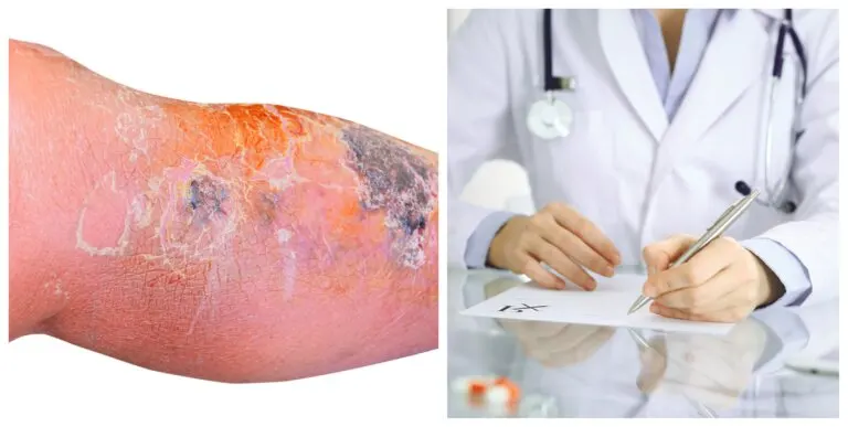 Tratamiento de la erisipela