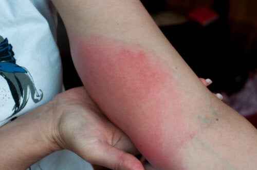 Enfermedad de Lyme