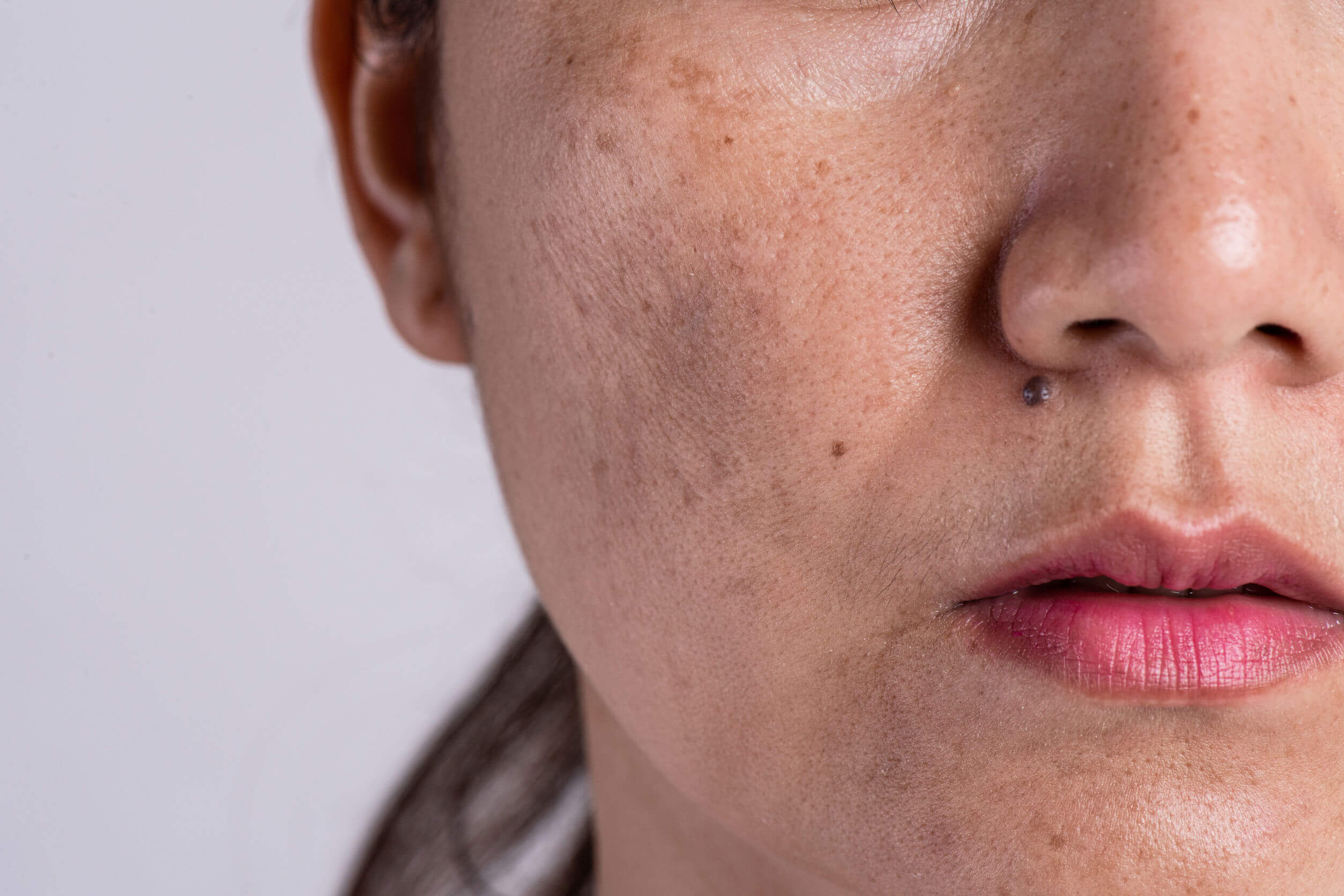 6 mitos sobre el acné que no te ayudarán a superarlo