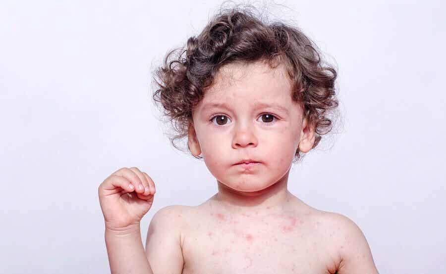 Niño con manchas sarampión