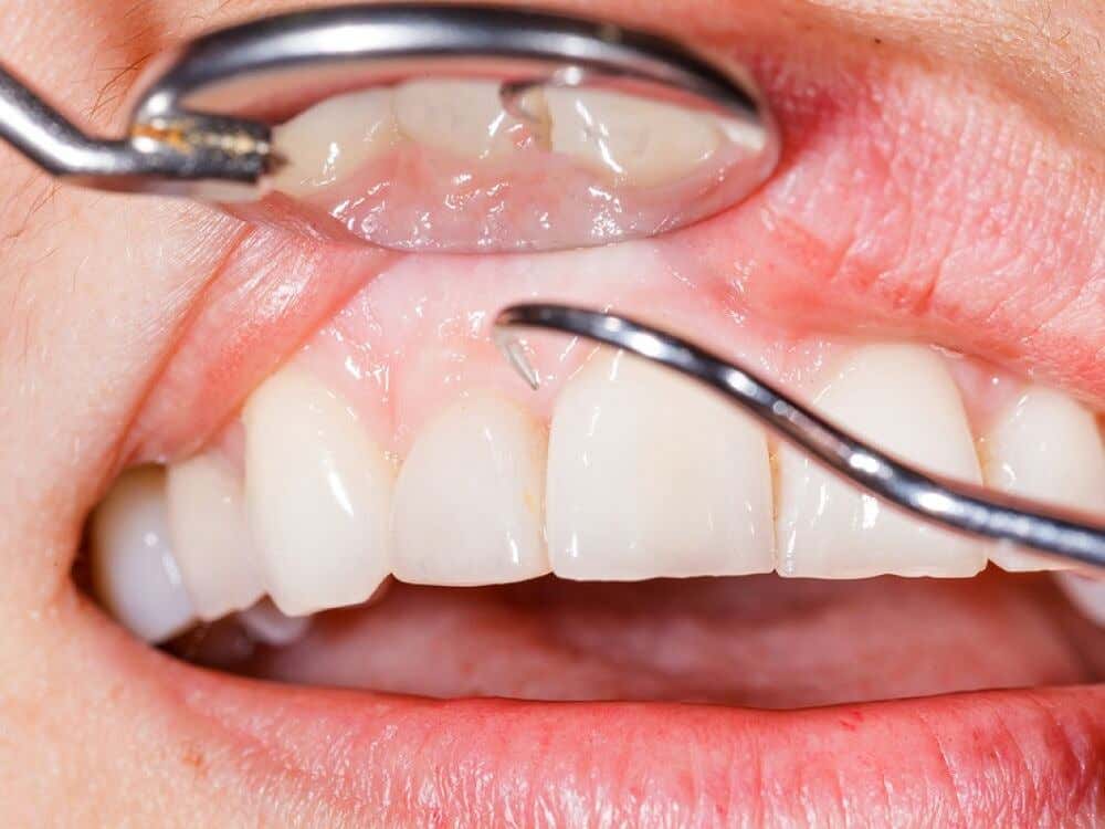 Placa dental revisada.