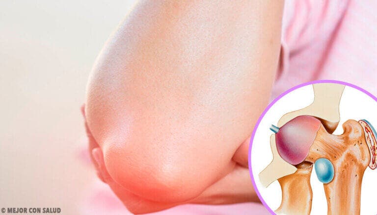Todo lo que deberías saber sobre la bursitis