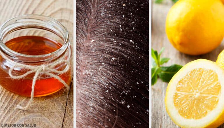 10 remedios naturales eficaces contra la caspa