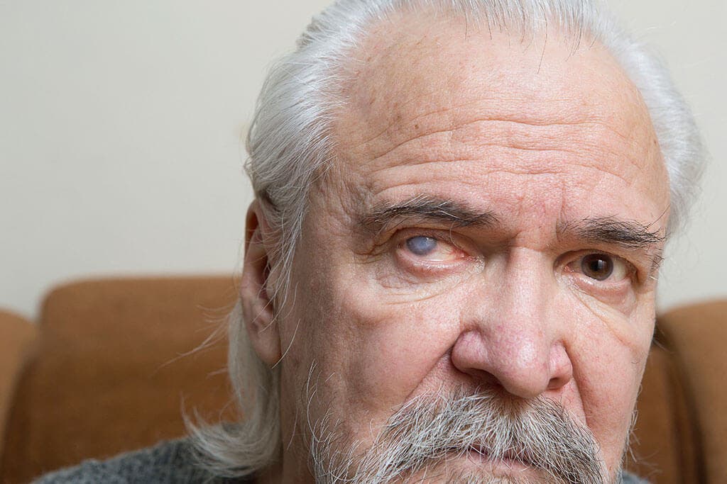 Man met ernstige cataract