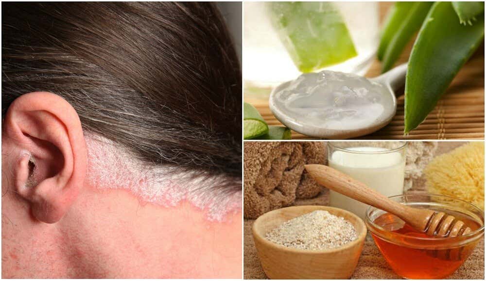 5 remedios caseros para la psoriasis en el cuero cabelludo