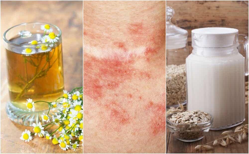 5 remedios caseros para tratar la dermatitis de contacto
