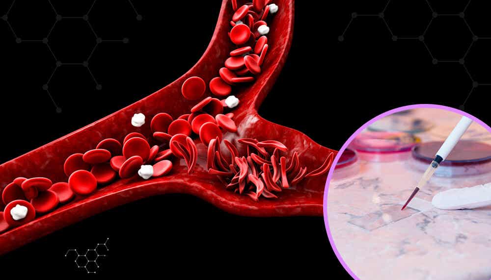 Anemia falciforme: todo lo que debes saber