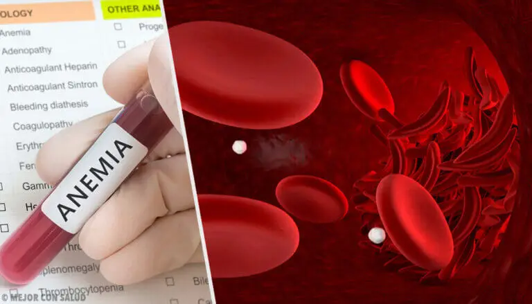 Anemia ferropénica: qué es y en qué consiste