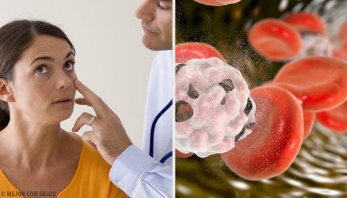 Anemia perniciosa: qué es y en qué consiste