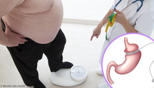 Bypass gástrico: qué es y en qué consiste