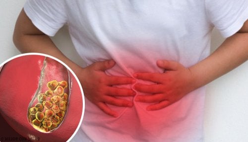 ¿Qué es la colelitiasis o cálculos en la vesícula?