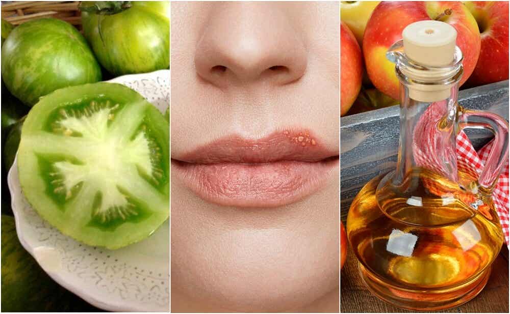 Cómo combatir el herpes labial con 5 tratamientos naturales