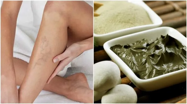 Cómo emplear arcilla verde en el tratamiento de las varices