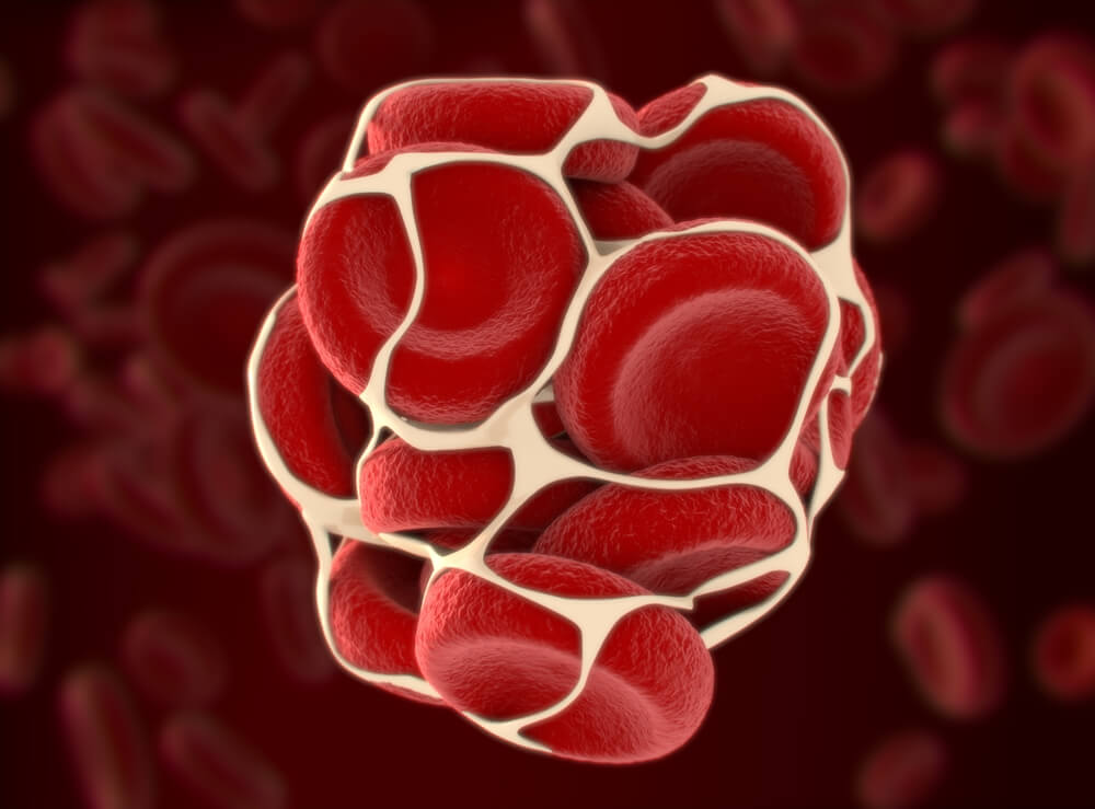 Tromboze hemoroidi bloke eden kan pıhtısı.