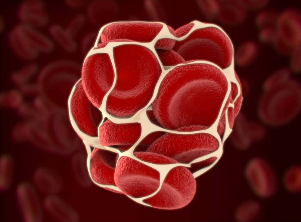 Ο θρόμβος αίματος εμποδίζει μια θρομβωμένη αιμορροΐδα.