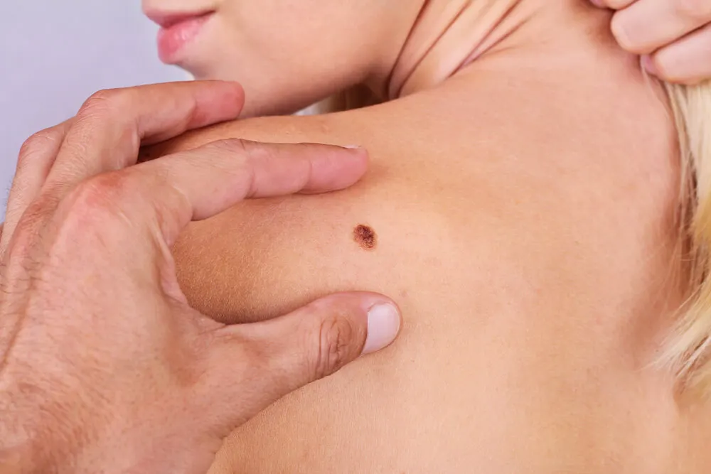 Diagnostico-del-melanoma-maligno