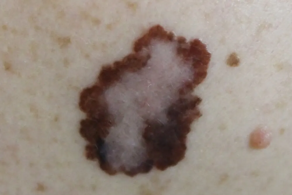 Factores-de-riesgo-y-tipos-de-melanomas-malignos