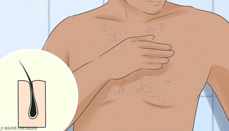 ¿Qué es la foliculitis? ¿Por qué se produce y cómo se trata?